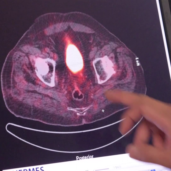Psma Pet Scan Image