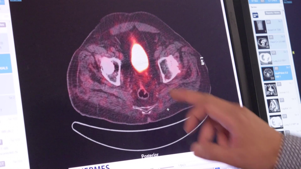 Psma Pet Scan Image