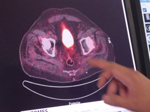 Psma Pet Scan Image